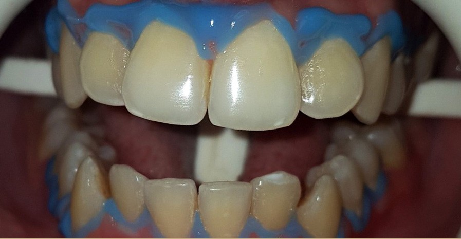 بعد تبيض-ليزر 4